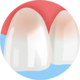 veneers